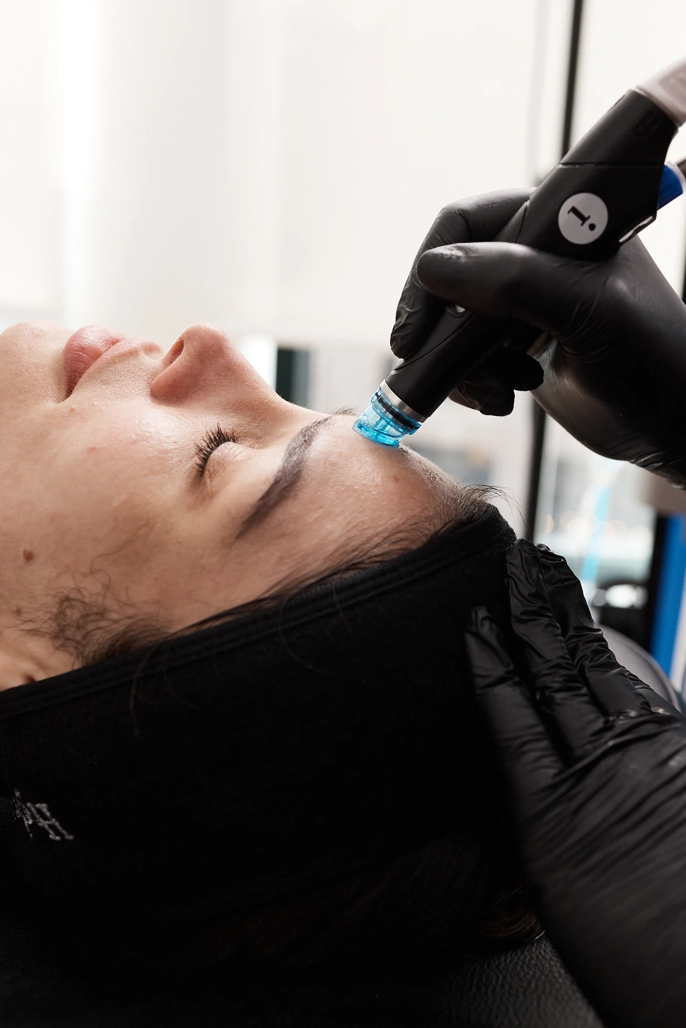 Microdermabrasion
