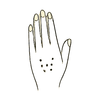 Radiesse mains